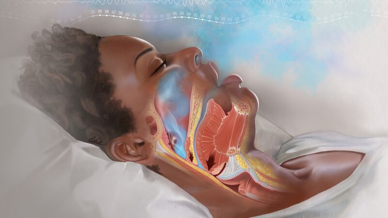 Australian_Study_Finds_Snoring_Linked_to_High_Blood_Pressure____ - News for amigos, by amigos Australian_Study_Finds_Snoring_Linked_to_High_Blood_Pressure____