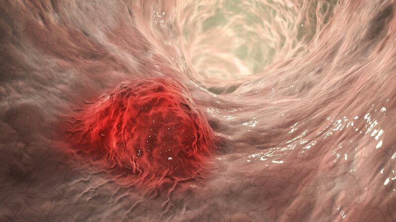 Chinese_Researchers_Unveil_Probiotic_Defense_Against_Colon_Cancer - News for amigos, by amigos Chinese_Researchers_Unveil_Probiotic_Defense_Against_Colon_Cancer