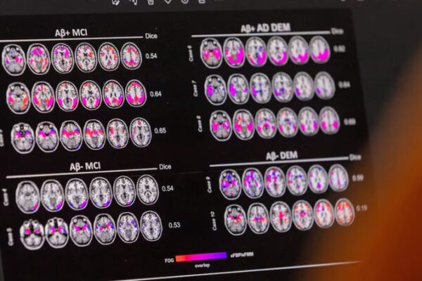 Double Trouble: Two APOE4 Genes May Lock in Alzheimer’s Risk 😮 Double_Trouble__Two_APOE4_Genes_May_Lock_in_Alzheimer_s_Risk__