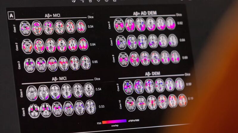 Double_Trouble__Two_APOE4_Genes_May_Lock_in_Alzheimer_s_Risk__ - News for amigos, by amigos Double_Trouble__Two_APOE4_Genes_May_Lock_in_Alzheimer_s_Risk__