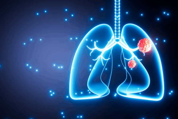 Air Pollution Sparks Lung Cancer Mutations in Nonsmokers Air_Pollution_Sparks_Lung_Cancer_Mutations_in_Nonsmokers