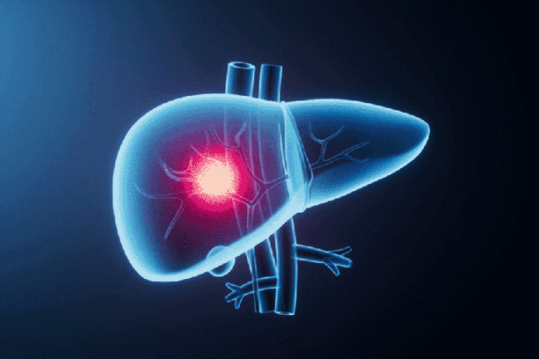 China-led Report Charts Global Blueprint to Beat Liver Cancer China_led_Report_Charts_Global_Blueprint_to_Beat_Liver_Cancer