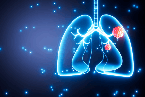 One in Five Lung Cancer Patients Are Nonsmokers, Study Shows One_in_Five_Lung_Cancer_Patients_Are_Nonsmokers__Study_Shows