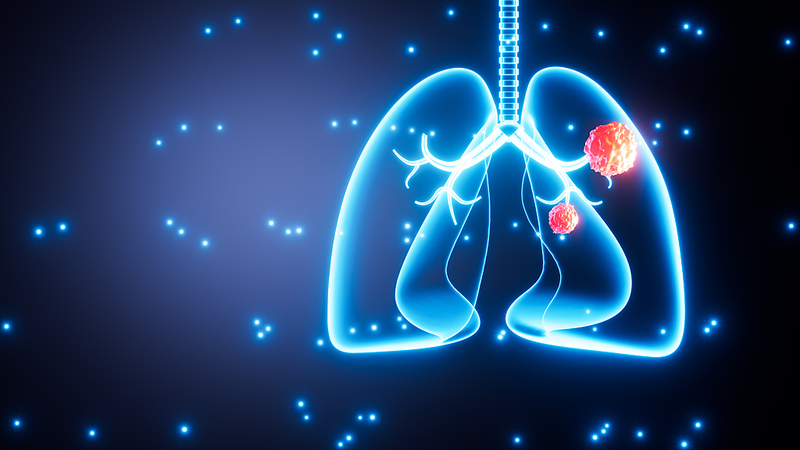 One_in_Five_Lung_Cancer_Patients_Are_Nonsmokers__Study_Shows - News for amigos, by amigos One_in_Five_Lung_Cancer_Patients_Are_Nonsmokers__Study_Shows