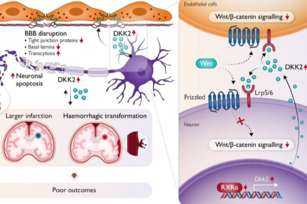 Chinese_Researchers_Pinpoint_Molecule_Behind_Post_Stroke_Brain_Damage